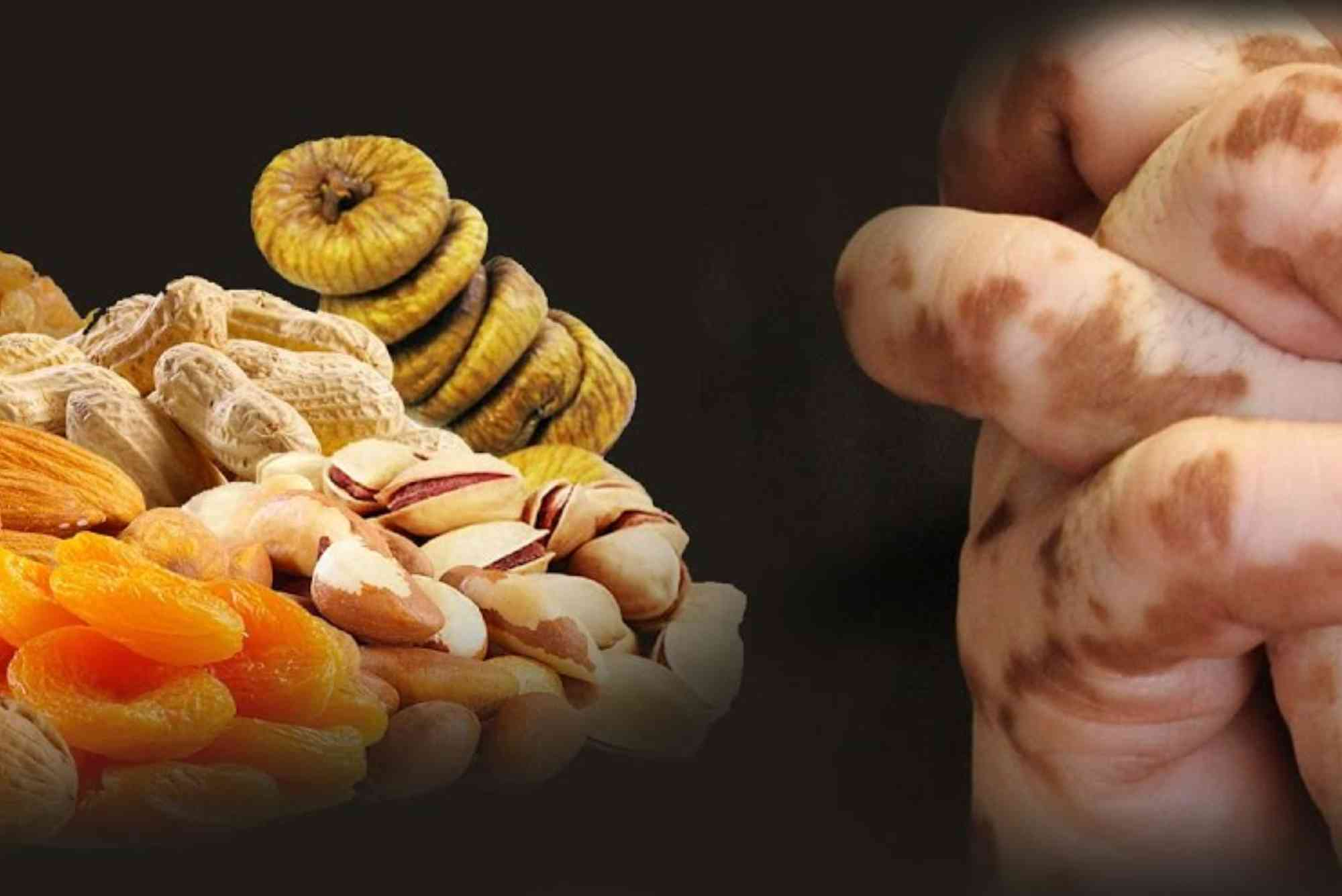 Dry Fruits for Vitiligo